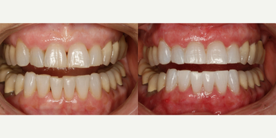 Teeth Whitening before and after photo