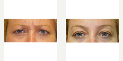 Botox before and after photo