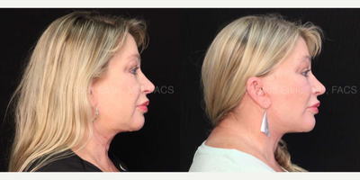 Facelift before and after photo