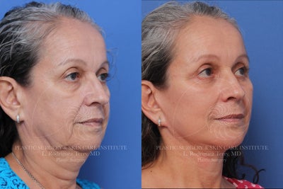 Facelift before and after photo