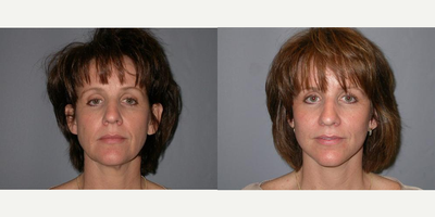 Mini Facelift before and after photo