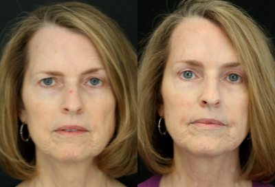 Brow Lift before and after photo