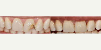 Dental Crown before and after photo