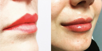 Dermal Fillers before and after photo