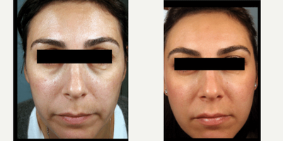 Eyelid Surgery before and after photo