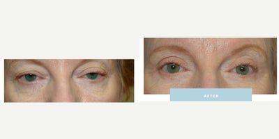 Eyelid Surgery before and after photo