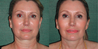 Facelift before and after photo