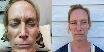 Jeuveau before and after photo
