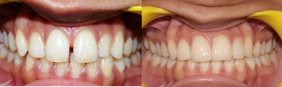 Porcelain Veneers before and after photo