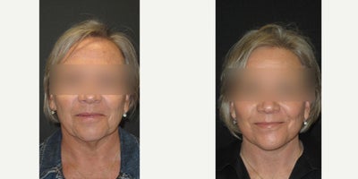 CO2 Laser before and after photo