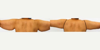 Arm Lift before and after photo