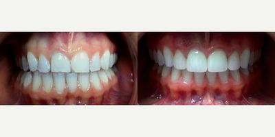 Dental Crown before and after photo