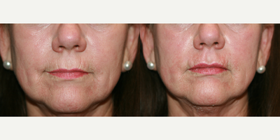 Dermal Fillers before and after photo