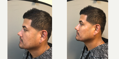 Dermal Fillers before and after photo
