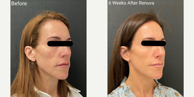 Dermal Fillers before and after photo
