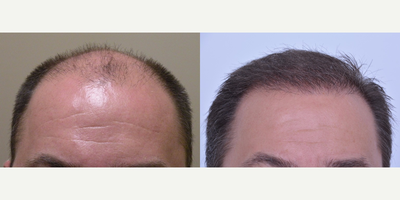 Hair Transplant before and after photo