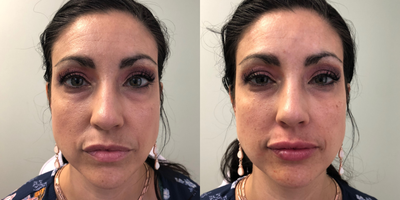 Juvederm before and after photo