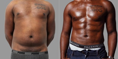Laser Liposuction before and after photo