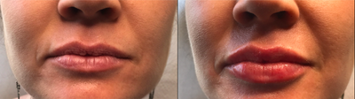 Lip Fillers before and after photo
