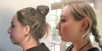Silikon 1000 before and after photo