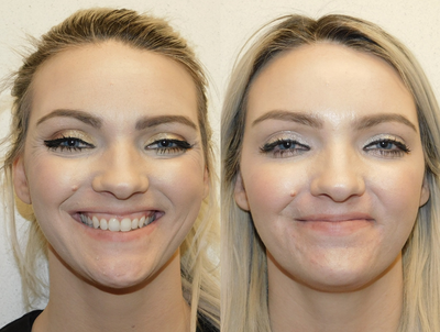 Dysport before and after photo