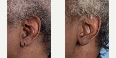 Earlobe Repair before and after photo