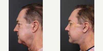Facelift before and after photo