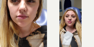 Lip Fillers before and after photo