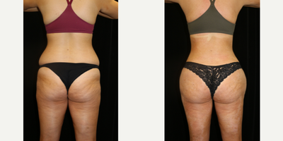 Liposuction before and after photo