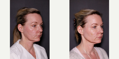 Restylane before and after photo