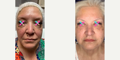 Thread Lift before and after photo
