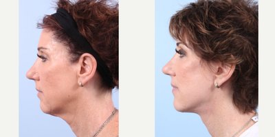 before and after image
