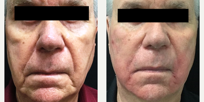 Dermal Fillers before and after photo