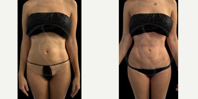 Liposculpture before and after photo