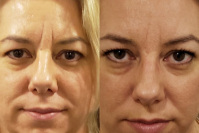 Restylane before and after photo