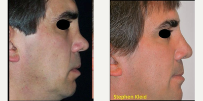 Revision Rhinoplasty before and after photo