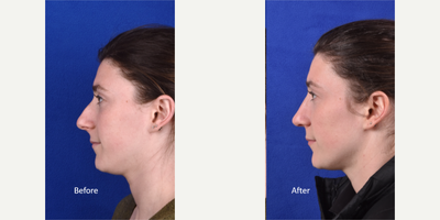 Rhinoplasty before and after photo