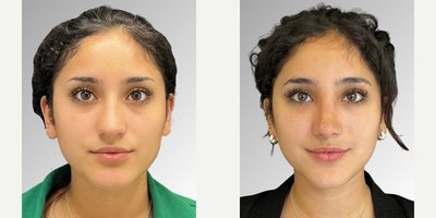Rhinoplasty before and after photo