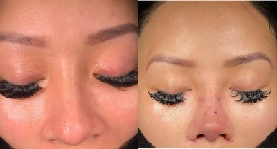 African American Rhinoplasty before and after photo