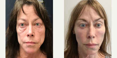 Bellafill before and after photo