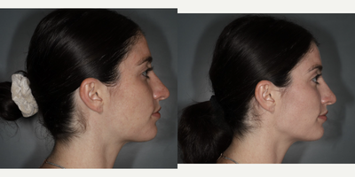 Chin Filler before and after photo
