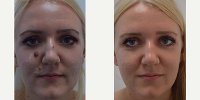 Mole Removal before and after photo