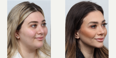 Revision Rhinoplasty before and after photo
