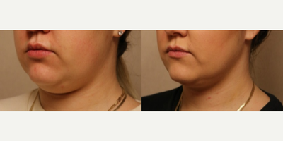 Chin Liposuction before and after photo