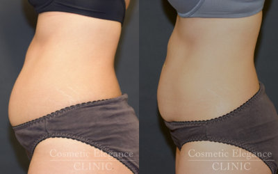 CoolSculpting before and after photo