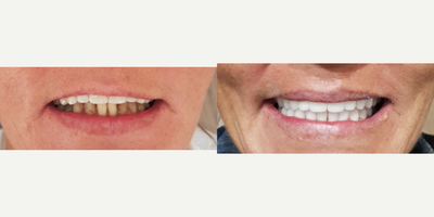 Dental Crown before and after photo