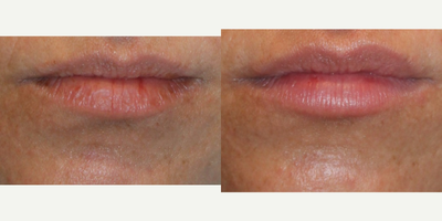 Restylane before and after photo