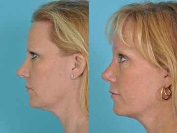 Rhinoplasty before and after photo