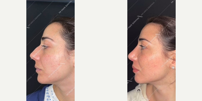 Septoplasty before and after photo