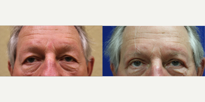 Eyelid Surgery before and after photo